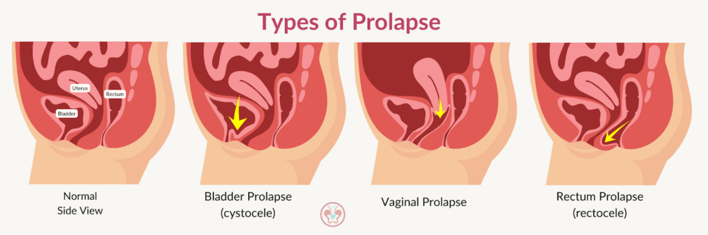 Different types of prolapse which can be impacted by running form