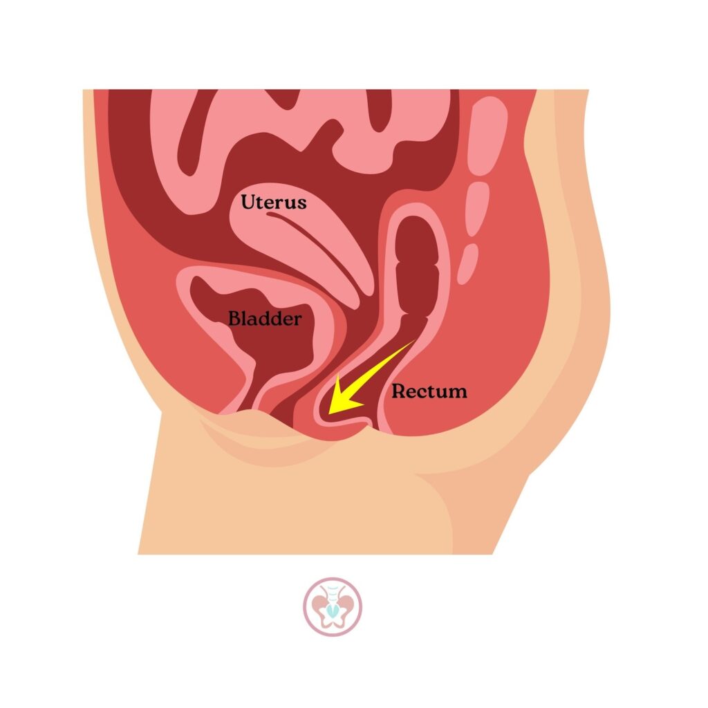 Side View of Rectal Prolapse